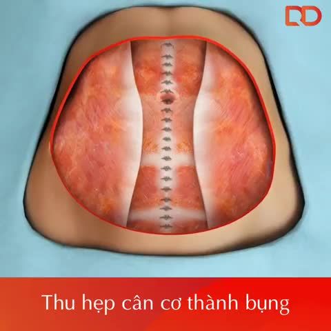 QUY TRÌNH CĂNG DA TOÀN BỤNG VASERLIPO ĐƯỢC THỰC HIỆN NHƯ THẾ NÀO