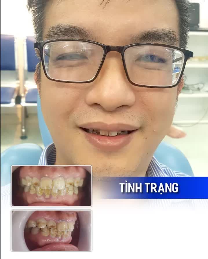 KIẾN TẠO ĐƯỜNG CƯỜI HOÀN HẢO CÙNG 20 RĂNG SỨ CERAMILL