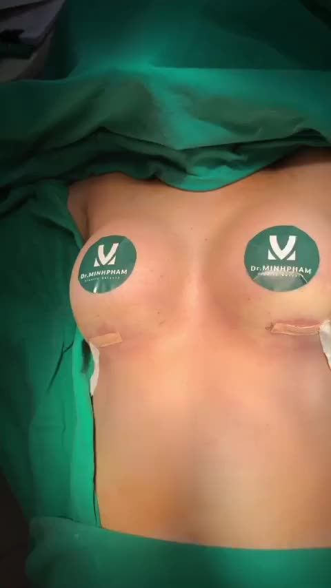 Ca Nâng Ngực Vừa Được Thực Hiện Bởi Ekip Dr. Minh Phạm