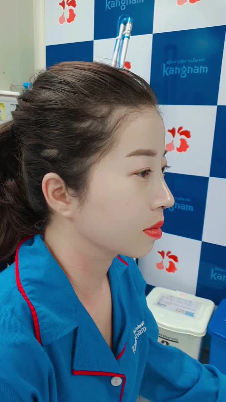 Khách hàng nâng mũi Sline 4D - Thay đổi ngoạn mục sau 45p phẫu thuật