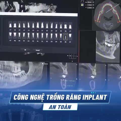 TRỒNG RĂNG IMPLANT CÔNG NGHỆ SAFE TECH - AN TOÀN, KẾT QUẢ BỀN VỮNG