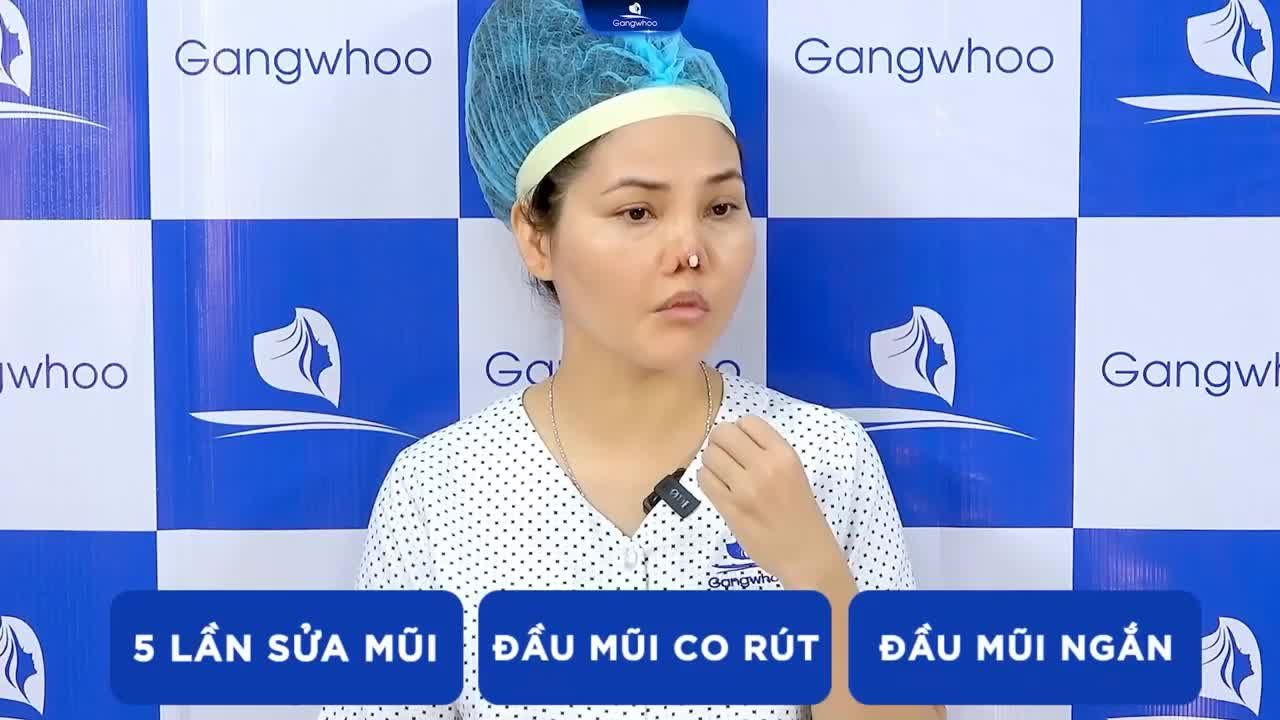 HÀNH TRÌNH GIAN NAN TÌM LẠI MŨI ĐẸP SAU 5 LẦN SỬA MŨI