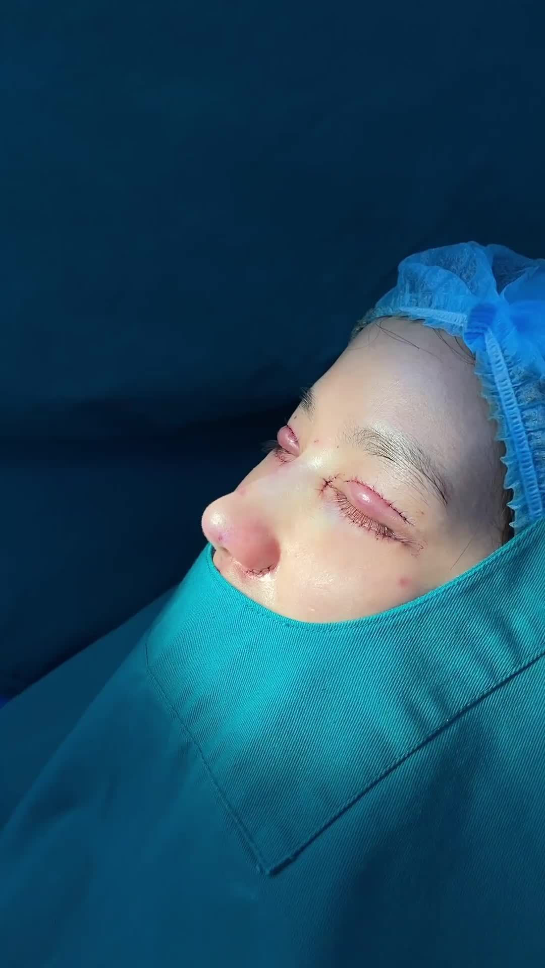 Kết quả combo Nâng mũi Surgiform + Perfect Eyes