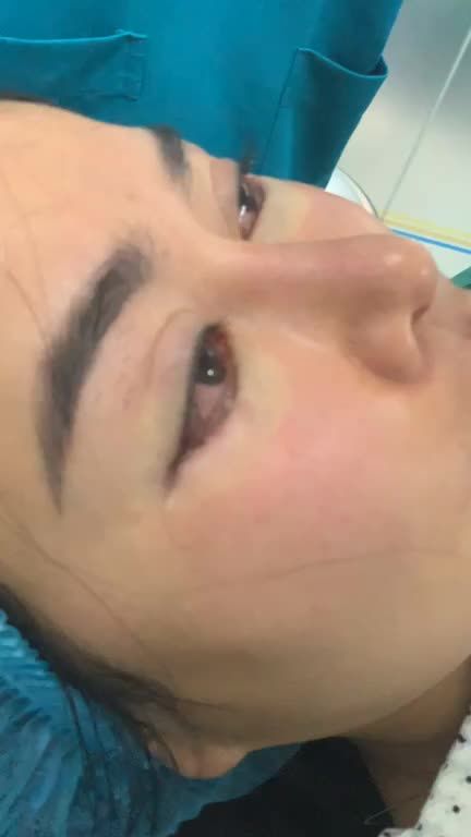 Mở góc mắt ngoài tạo mắt to hình giọt lệ Trung Hoa với Dr Vương !