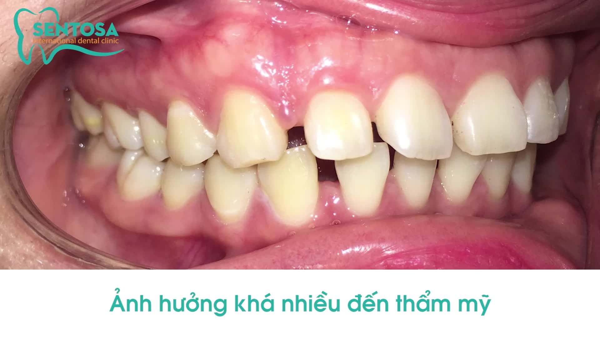 SỰ KỲ DIỆU CỦA INVISALIGN