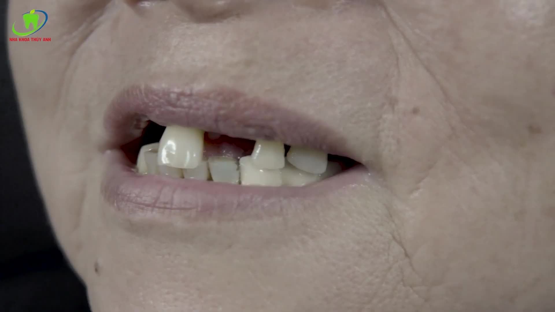 4 TRỤ IMPLANT VÀ LỜI HỨA XÓA BỎ NỖI LO ĐAU RĂNG CHO CÔ BÌNH