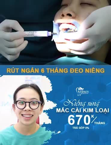MẮC CÀI KIM LOẠI GIÚP TĂNG HIỆU QUẢ NIỀNG RĂNG NHƯ THẾ NÀO