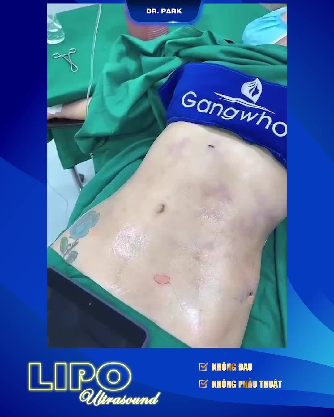 TẠI SAO HÚT MỠ BẰNG CÔNG NGHỆ LIPO ULTRASOUND KHÔNG ĐAU