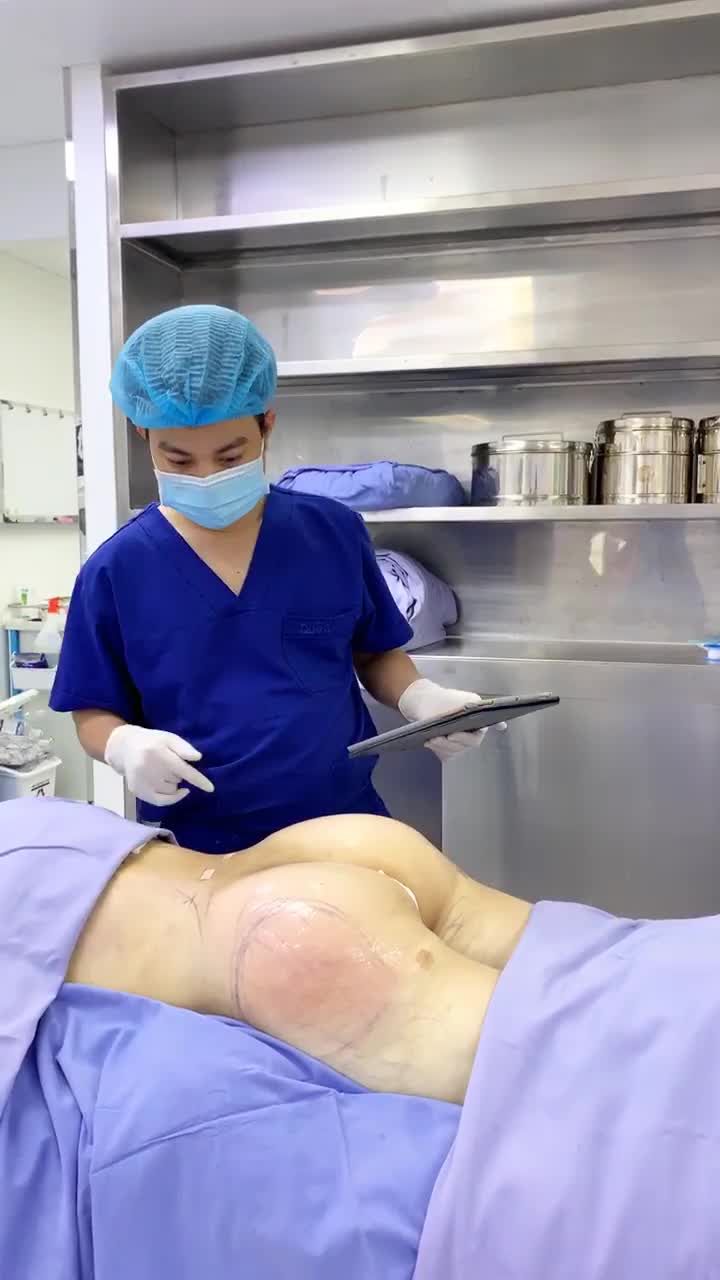 Kết Quả Đặt Túi Mông Kết Hợp Cấy Mỡ Mông Tại Bệnh Viện Thẫm Mỹ Đông Á