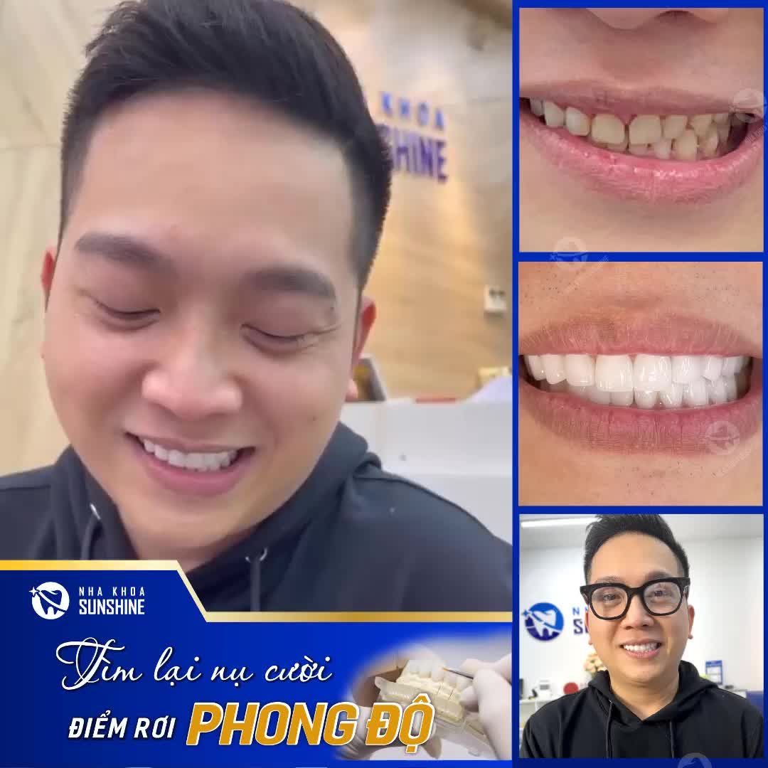 TÌM LẠI NỤ CƯỜI PHONG ĐỘ VỚI 20 RĂNG SỨ HT SMILE