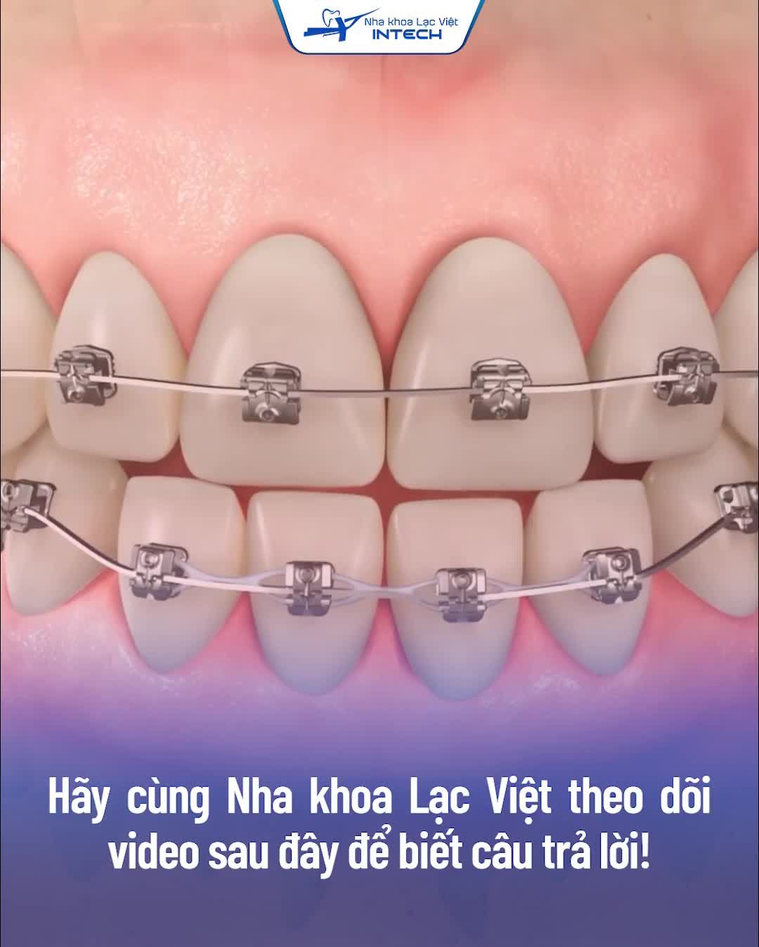 Mắc cài thường và mắc cài tự buộc là 2 loại mắc cài phổ biến trong chỉnh nha.