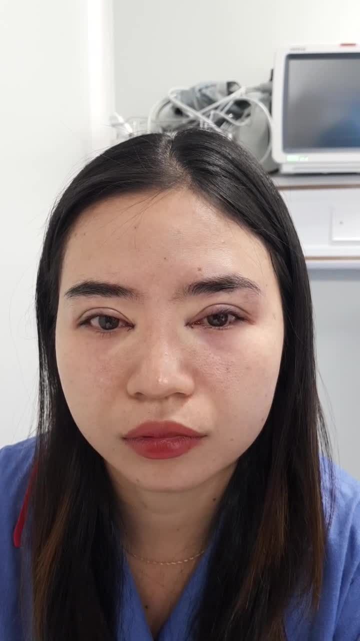 Tò mò muốn biết Cắt mí + Tạo khóe trong cùng lúc, kết quả sẽ ra sao