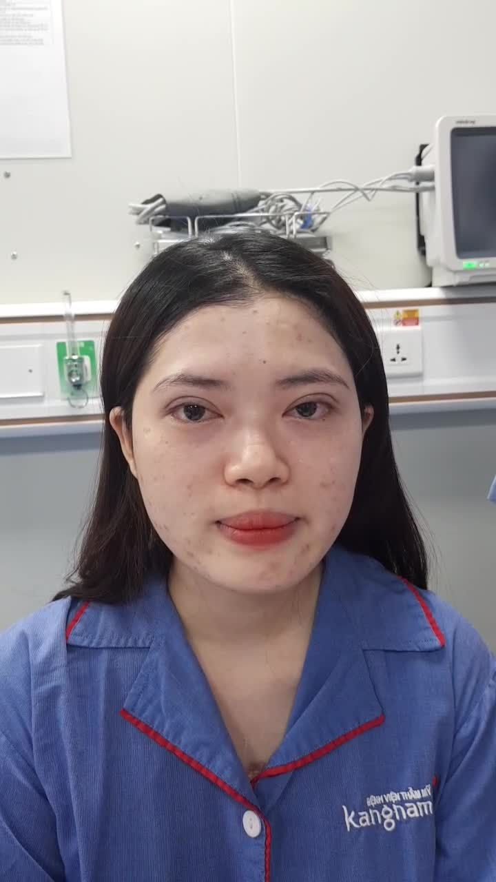Cận cảnh vừa xong ca Cắt mí số 48 trong ngày