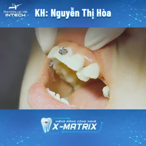 Nha khoa Lạc Việt Intech luôn giữ tinh thần làm việc hăng say, hết lòng vì bệnh nhân