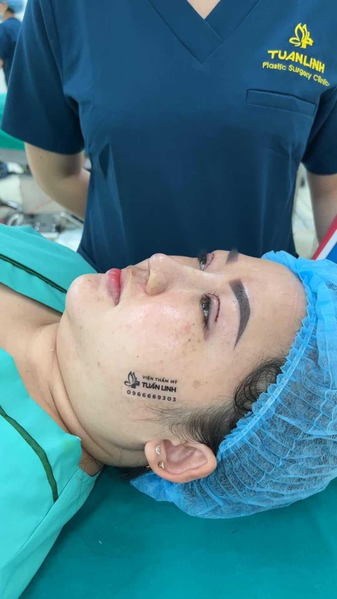 Nâng mũi bọc Megaderm cho khách hàng đến từ Huế!