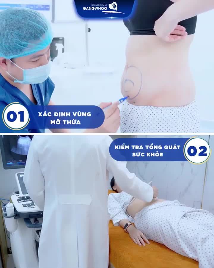 TẠI SAO BẠN VẪN PHẢI TẬP LUYỆN SAU HÚT MỠ