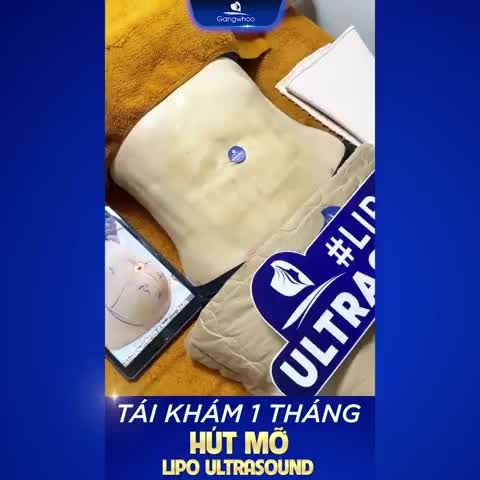 KHÁCH HÀNG TÁI KHÁM SAU 1 THÁNG  HÚT MỠ BỤNG BẰNG CÔNG NGHỆ LIPO ULTRASOUND