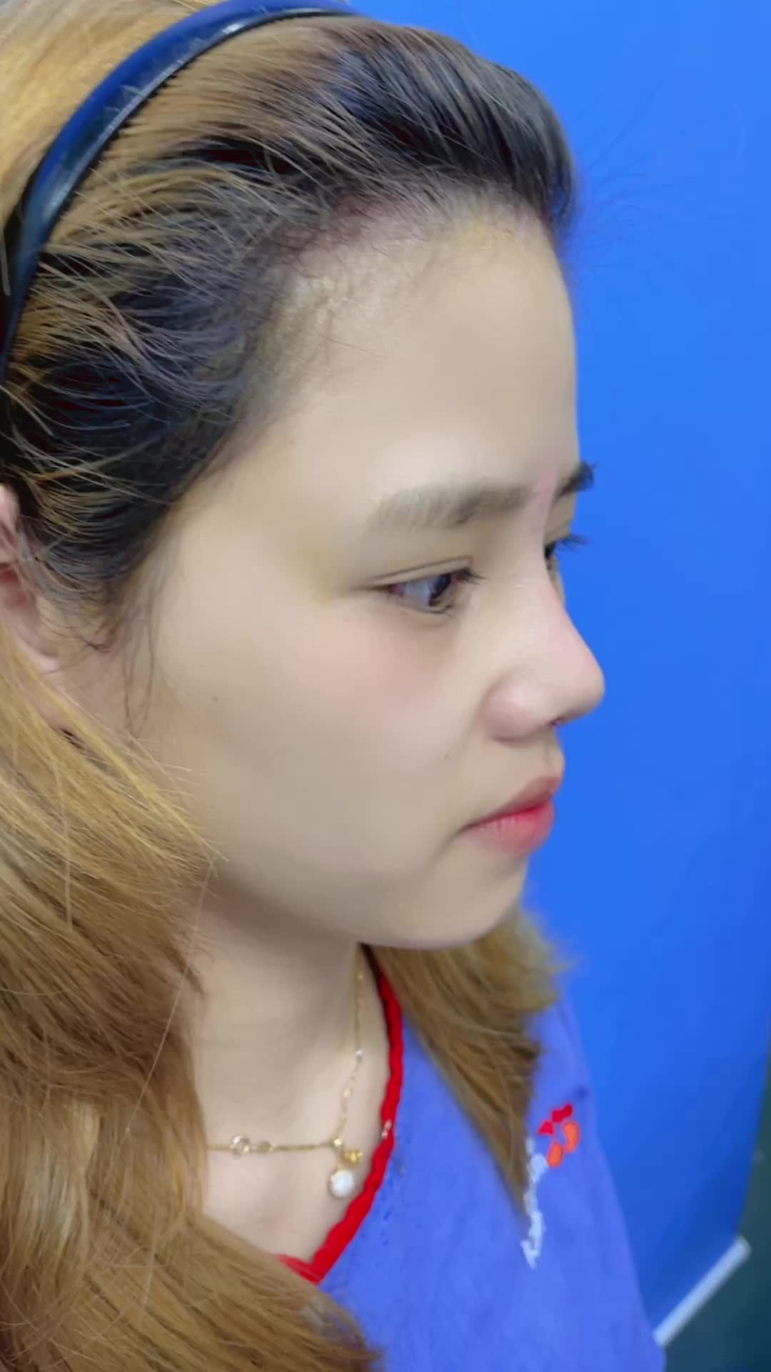 Nhập hội hệ Hotgirl không thể bỏ qua Nâng mũi cấu trúc 4D Pureform