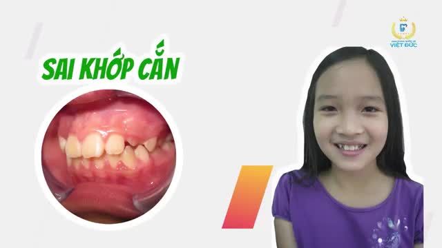 CÁC TRƯỜNG HỢP CẦN NIỀNG RĂNG CHO BÉ