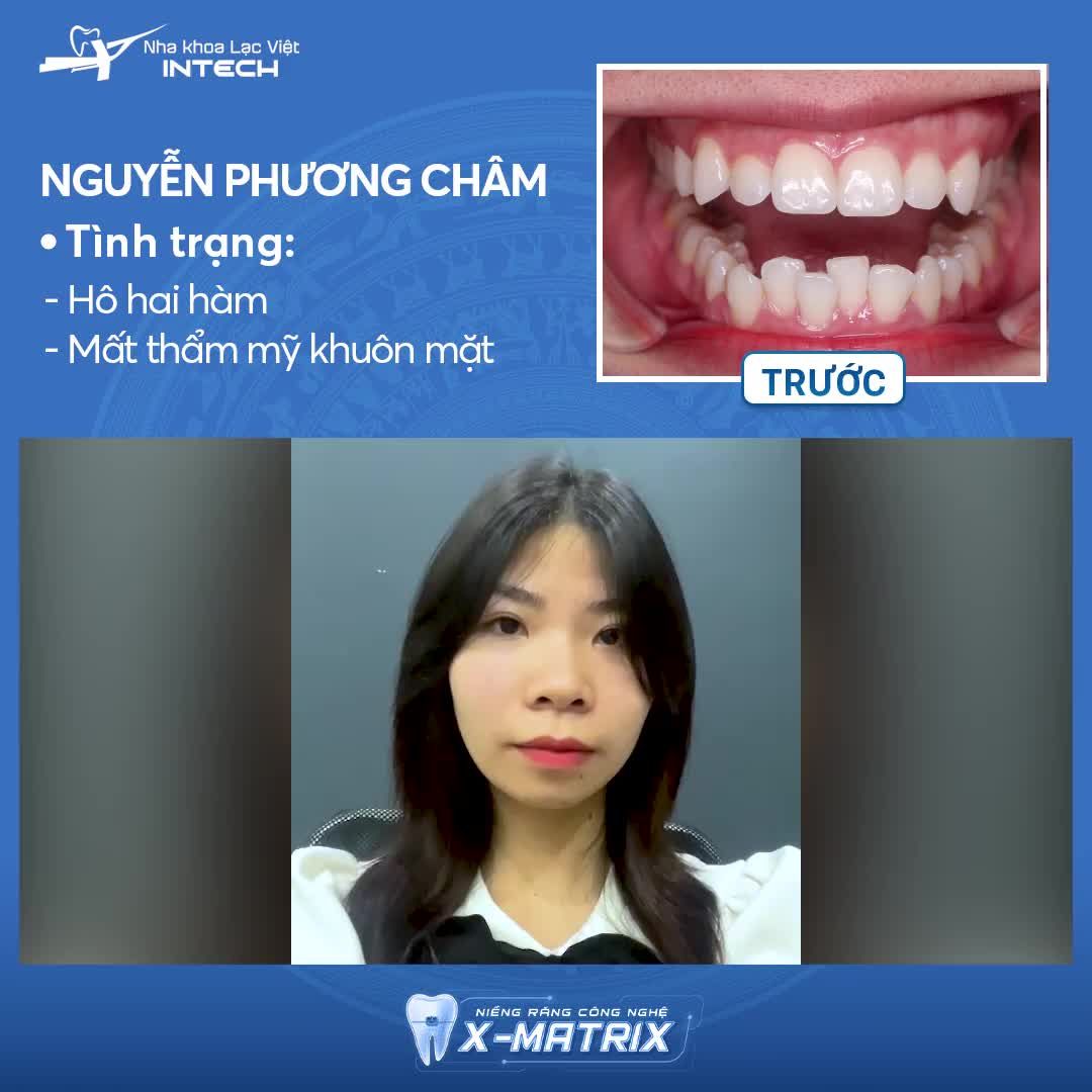 Thì ra…Cười xinh…là vì niềng răng X- Matrix