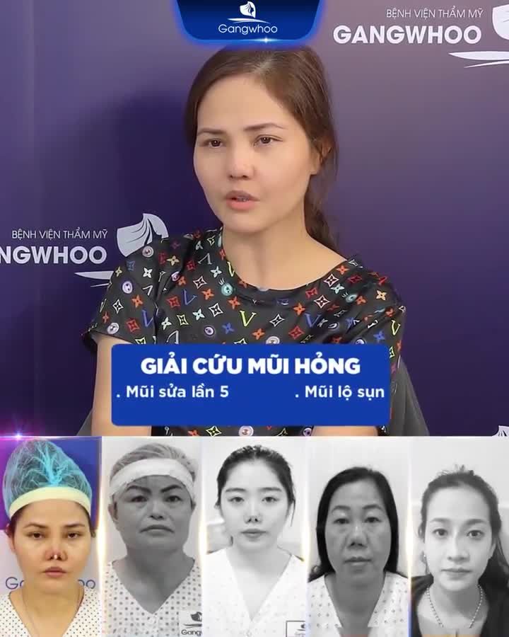 TOP 5 CA SỬA MŨI HỎNG ĐỈNH CAO NHÀ DR PARK!