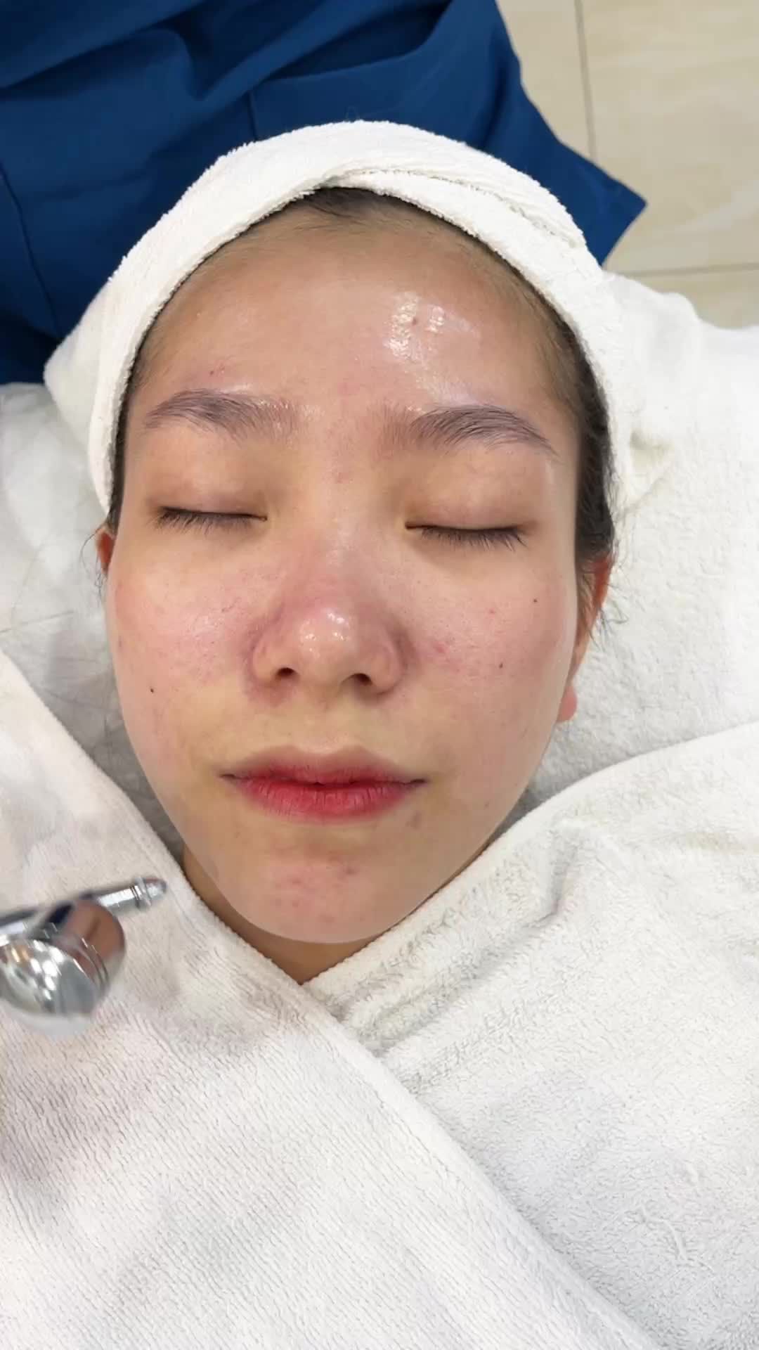 Trải nghiệm TRỊ MỤN DE ACNE 0 đồng tại Kangnam - Chỉ 2 từ thôi QUÁ ĐÃ