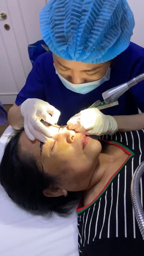 Quá trình cắt chỉ nâng cung và cắt mí tại Bệnh viện thẩm mỹ Đông Á