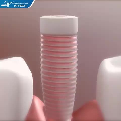CÁC LOẠI TRỤ IMPLANT KHÁC NHAU NHƯ THẾ NÀO