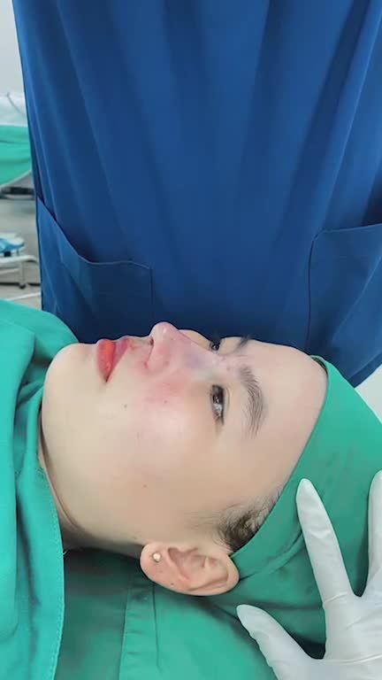 Ca nâng mũi cấu trúc Surgiform sửa lại sau 90 phút thực hiện.