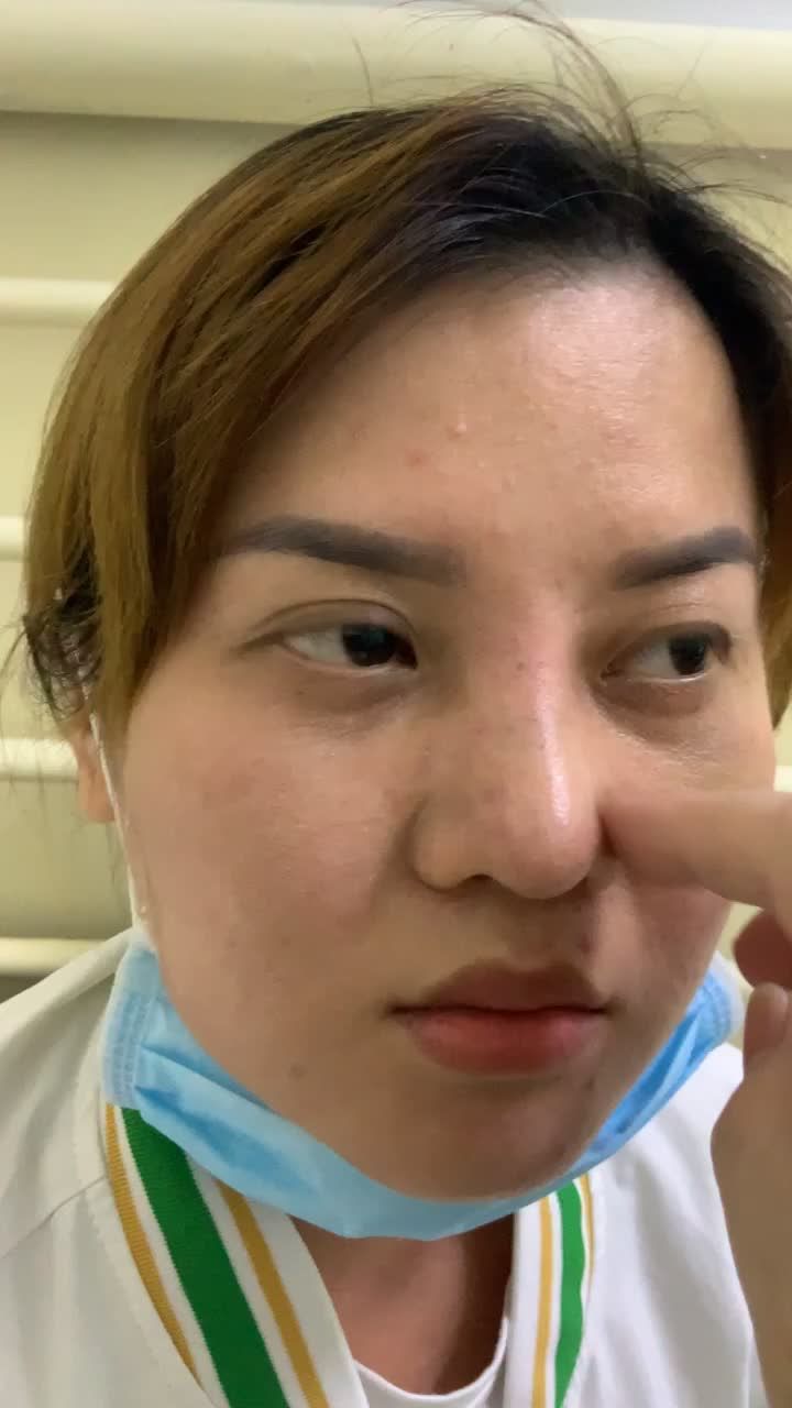 Kết quả sửa mũi = mũi cấu trúc sửa sẹo má sau 02 tuần với Dr Vương !