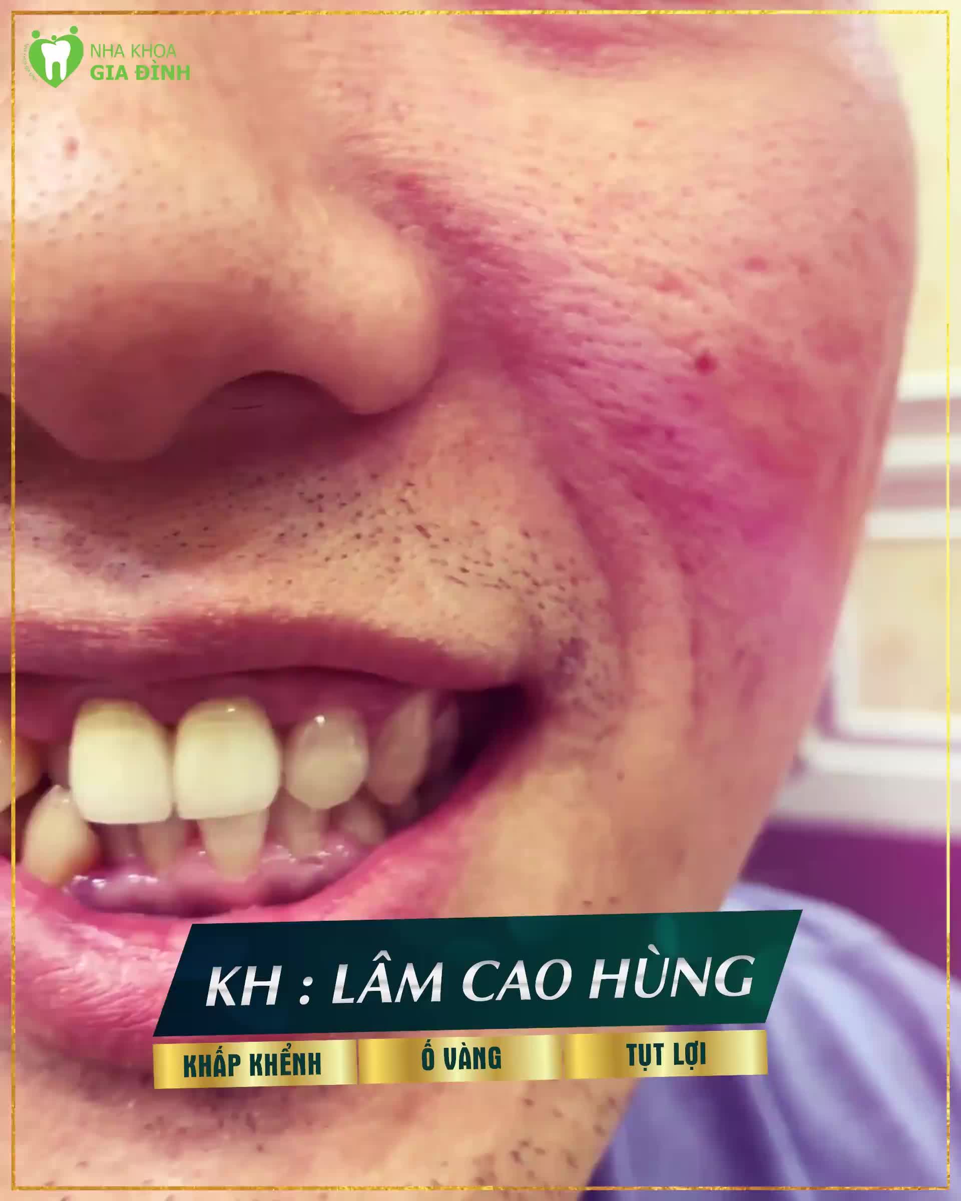 LỘT XÁC NGOẠN MỤC  HÀM RĂNG Ố VÀNG, KHẤP KHỂNH