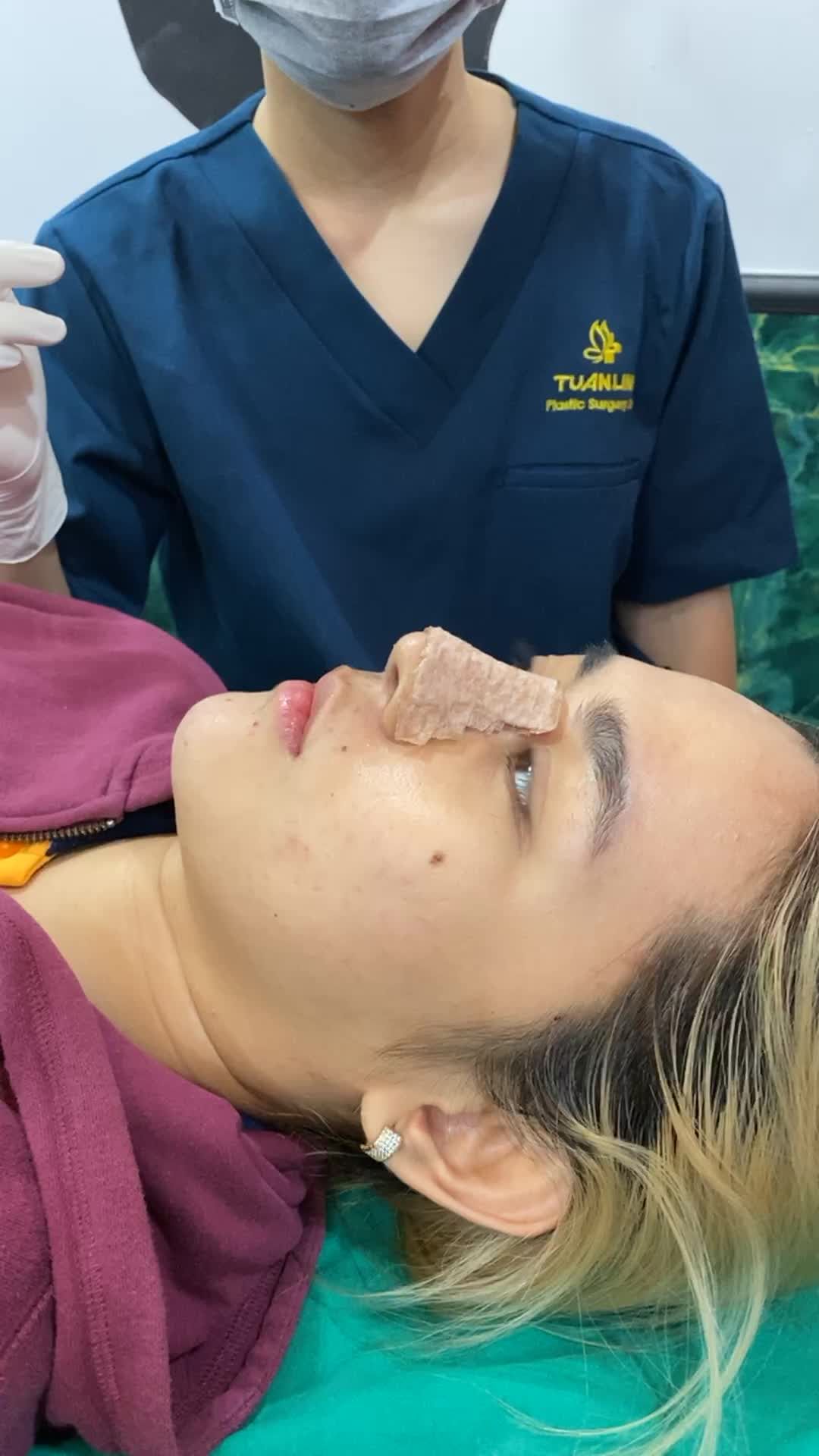 Case nâng mũi cấu trúc tái khám sau 10 ngày.