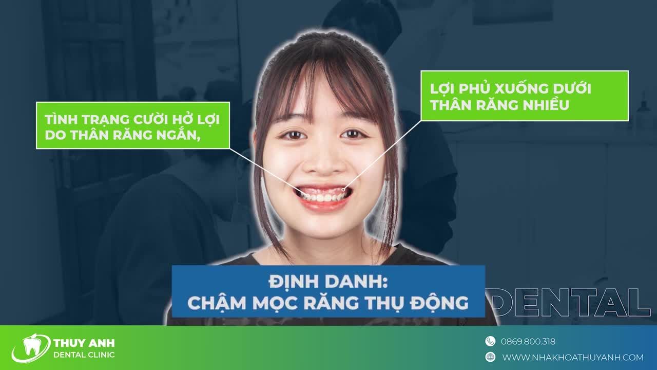 CHỮA CƯỜI HỞ LỢI HIỆU QUẢ TỨC THÌ