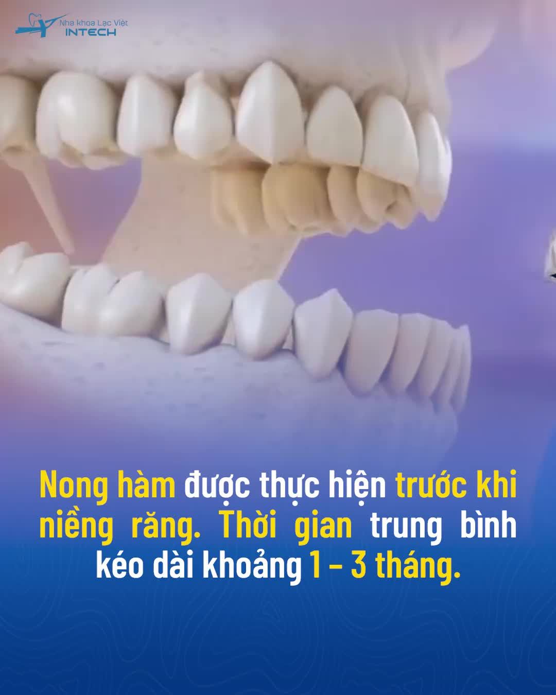 KHÁM PHÁ KỸ THUẬT NONG HÀM TRONG CHỈNH NHA