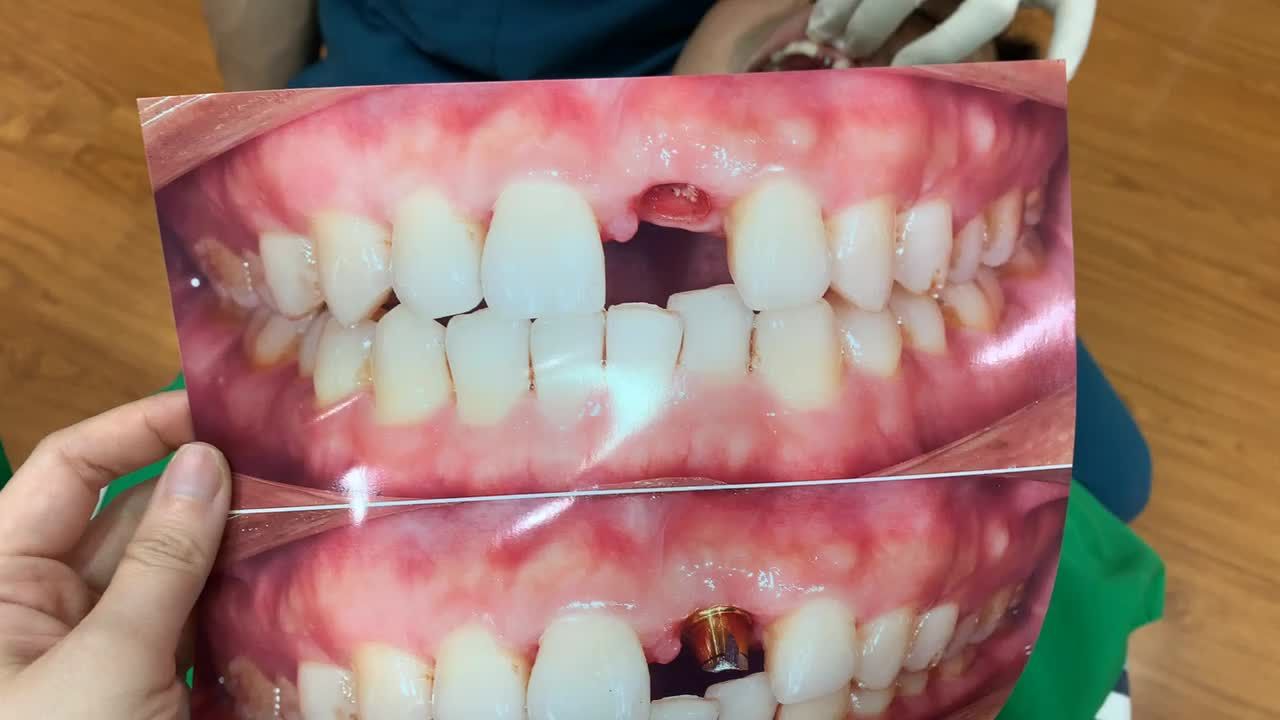 lắp răng implant khôi phục lại răng cửa bị mất cho anh khách hàng tại Nha Khoa Thùy Anh.