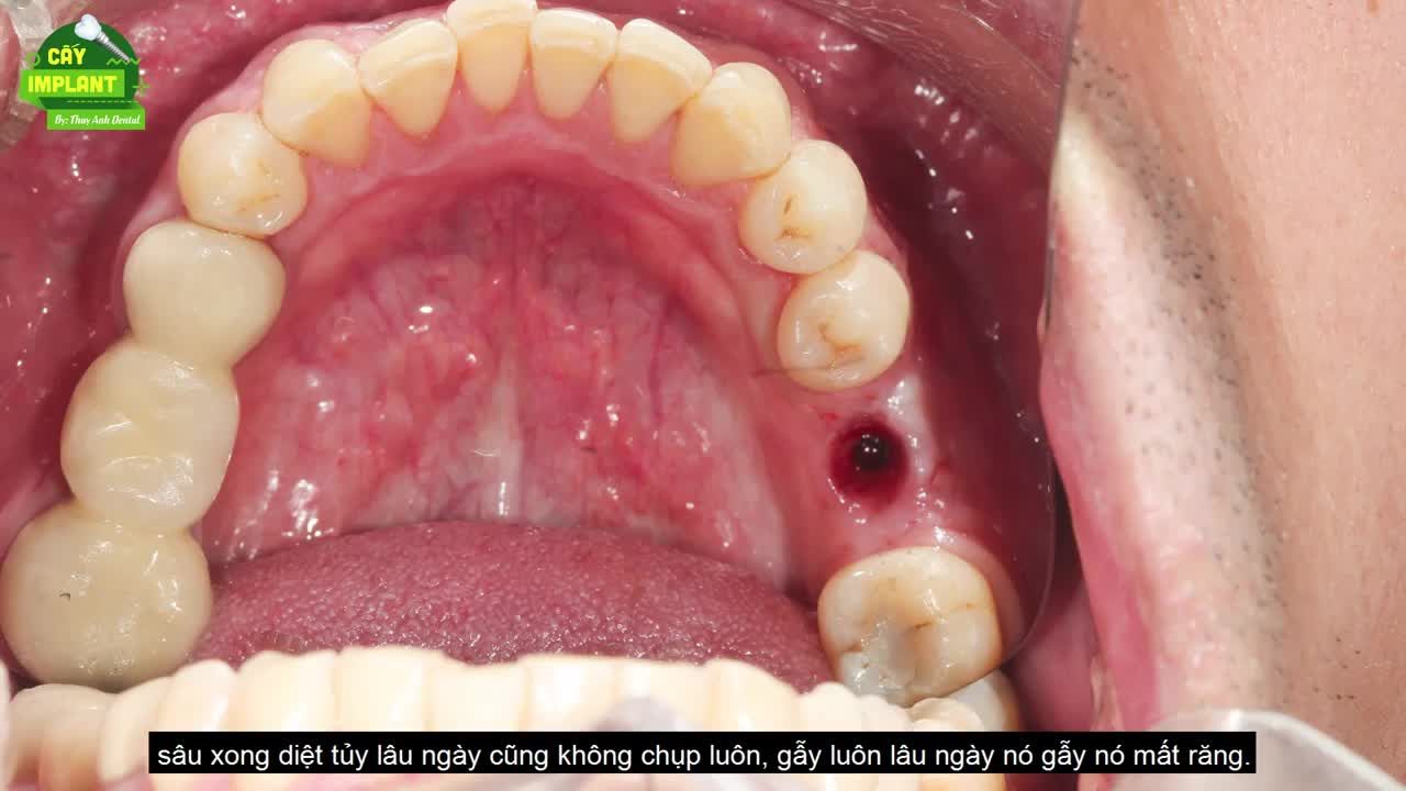 NÊN SỬ DỤNG CẦU RĂNG HAY RĂNG IMPLANT