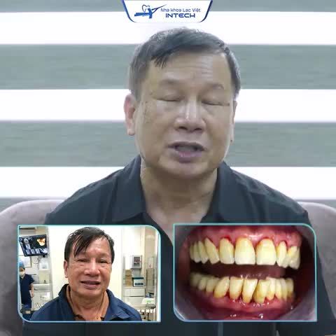 RĂNG KHỎE, ĐẸP NHỜ TRỒNG RĂNG IMPLANT CÔNG NGHỆ SAFE-TECH