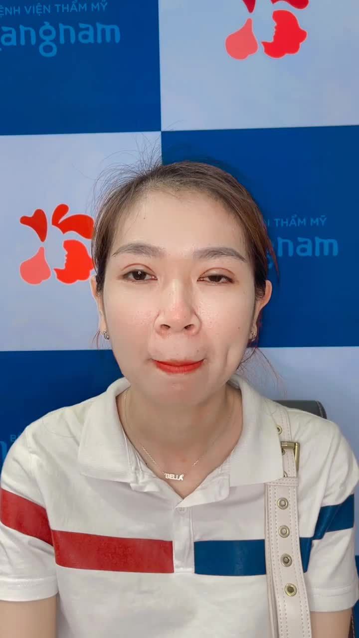 Bớt ngờ với nếp mí tuyệt đẹp của Khách hàng sau 7 ngày phẫu thuật