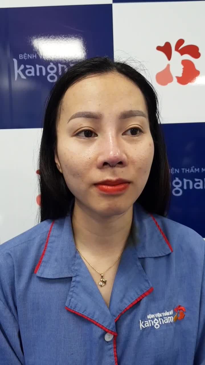 Trực tiếp khách hàng vừa nâng mũi Cấu trúc 4D - Dáng mũi S-Line tại Kangnam 666 Cách Mạng Tháng 8