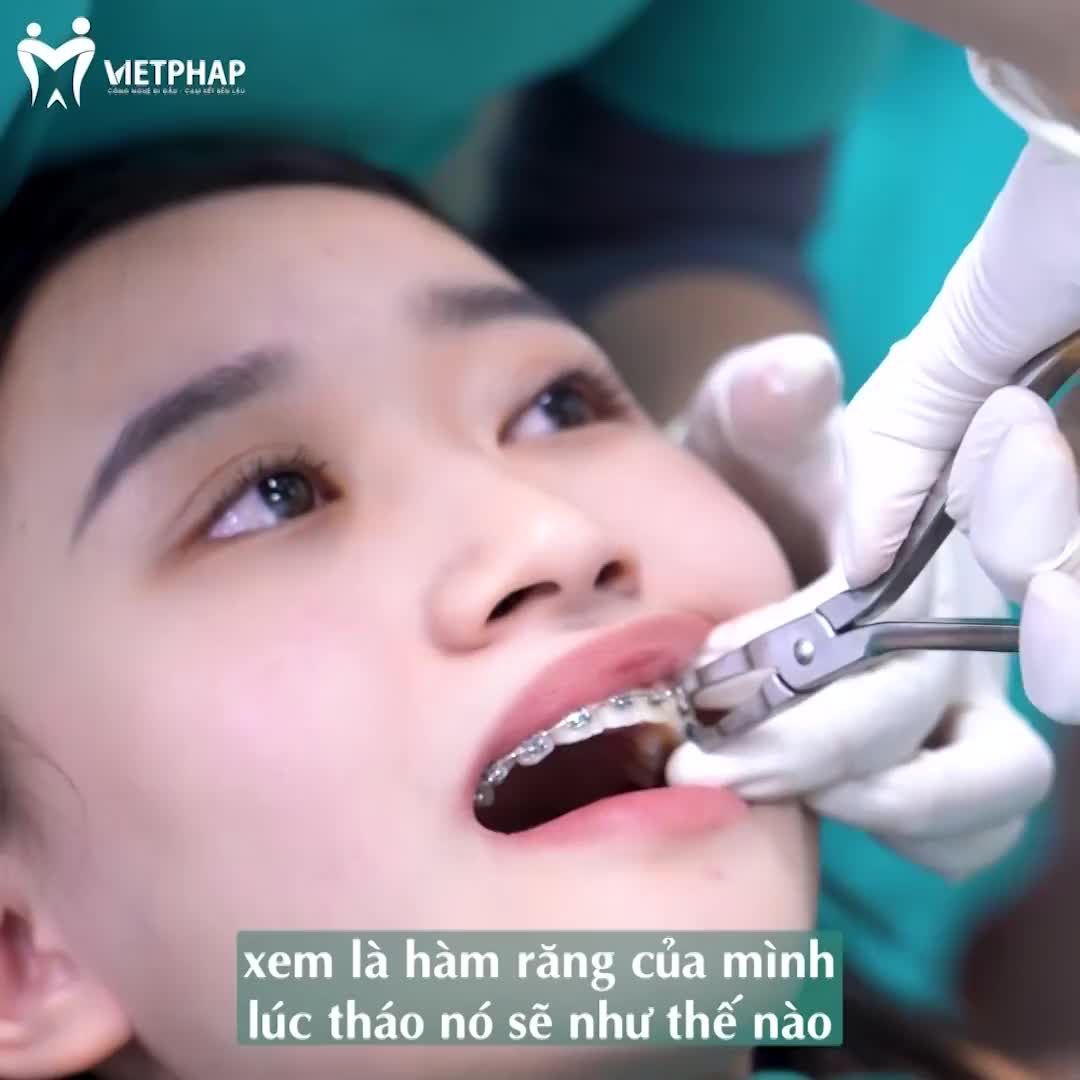 NIỀNG RĂNG SMART CLIP 3D KHẮC PHỤC RĂNG HÔ NHƯ THẾ NÀO?