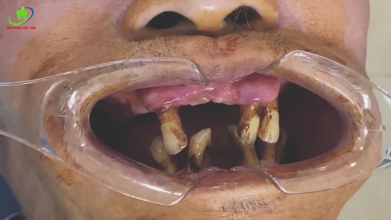 HÀM ALL ON 4 CÓ Ý NGHĨA NHƯ THẾ NÀO VỚI CÔ CHÚ Ở TUỔI TRUNG NIÊN