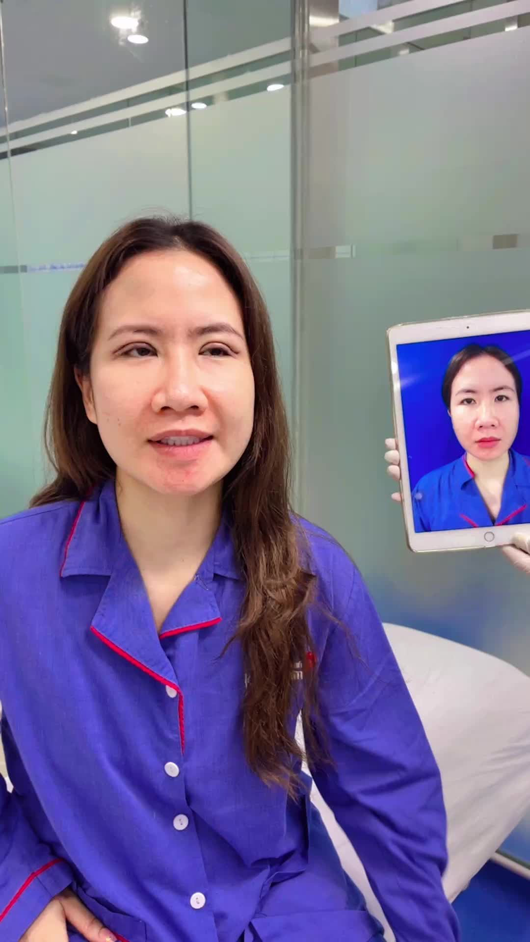 Vừa CẮT MÍ mà MẮT KHÔNG SƯNG Tác dụng KÌ DIỆU của Cắt mí Plasma‼️