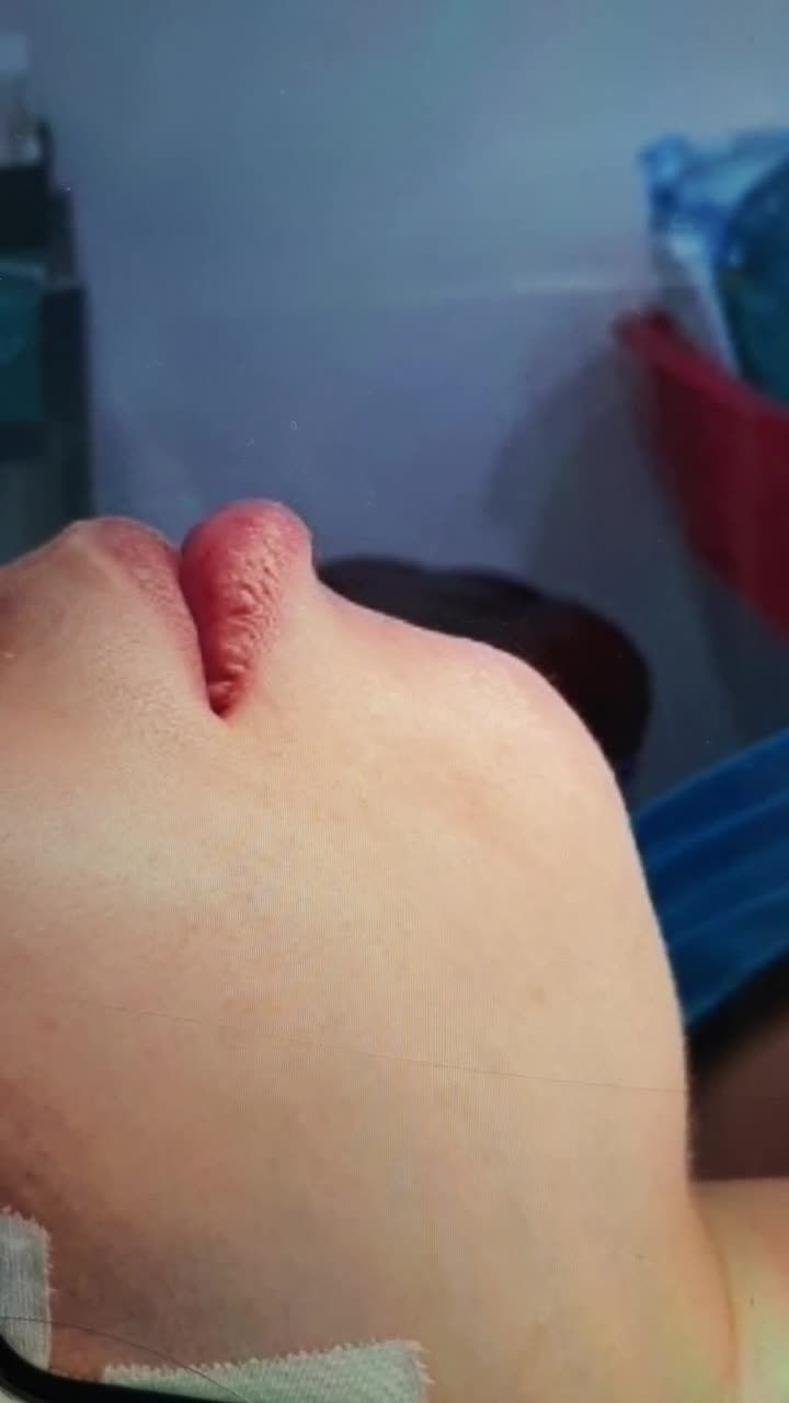 ĐỘN CẰM VLINE - GƯƠNG MẶT THON GỌN