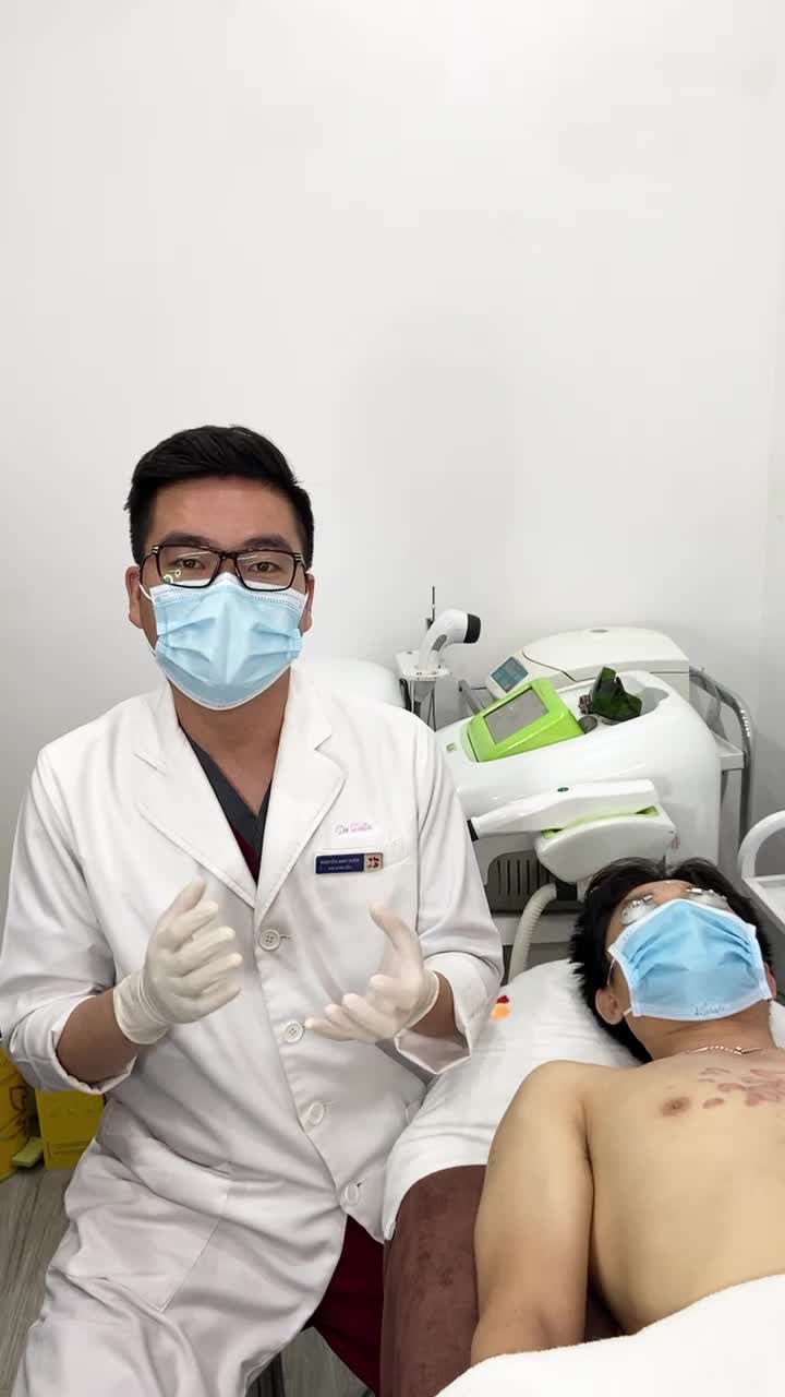 Điều trị sẹo lồi lâu năm bằng ánh sáng Ella kết hợp cấy huỷ xơ sẹo!