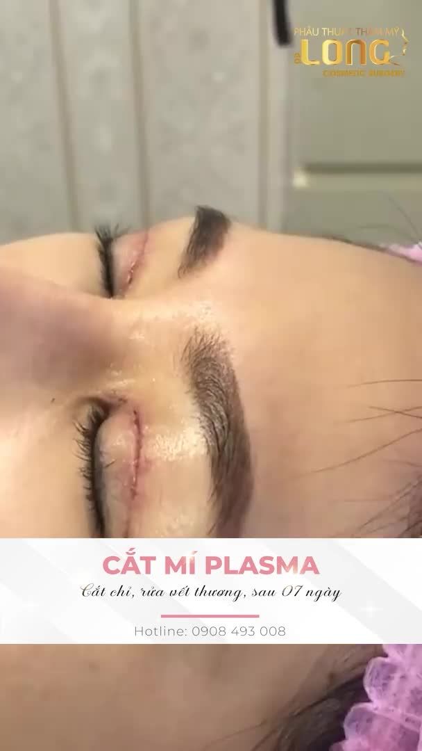 Khách hàng thực hiện cắt mí, sau 7 ngày tái khám và cắt chỉ