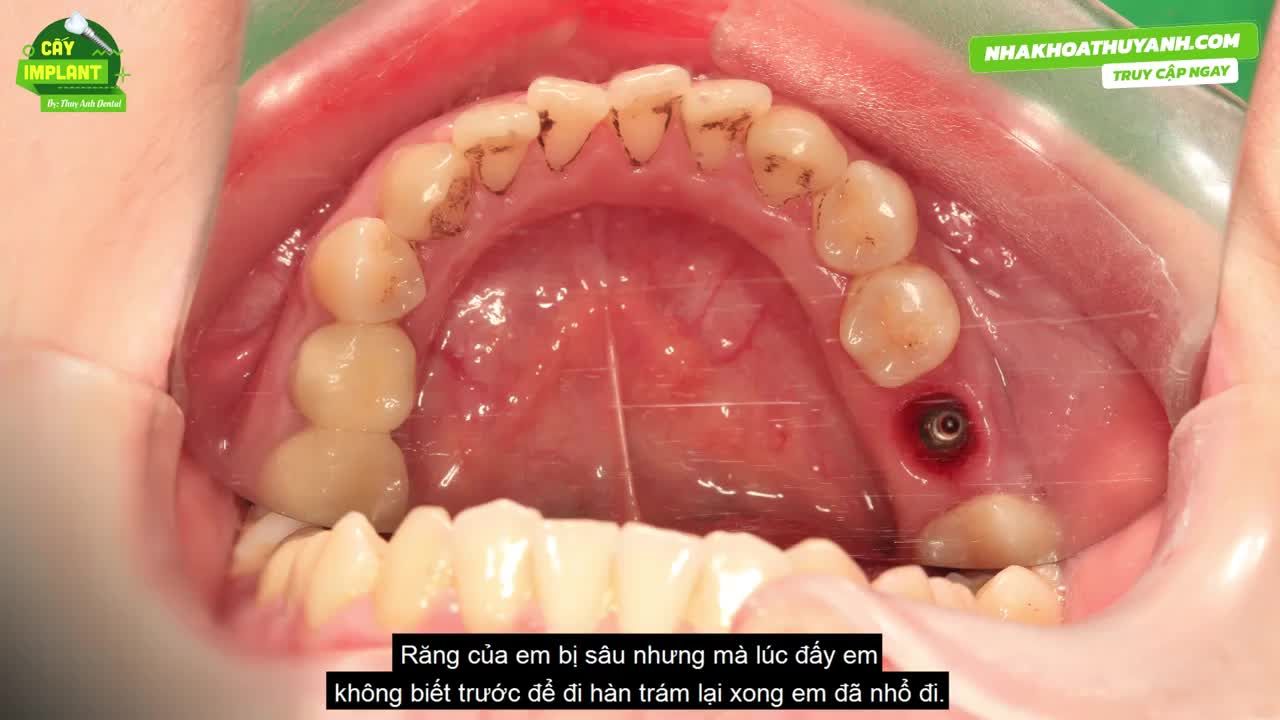IMPLANT - GIẢI PHÁP SỐ 1 CHO NHỮNG TRƯỜNG HỢP MẤT RĂNG