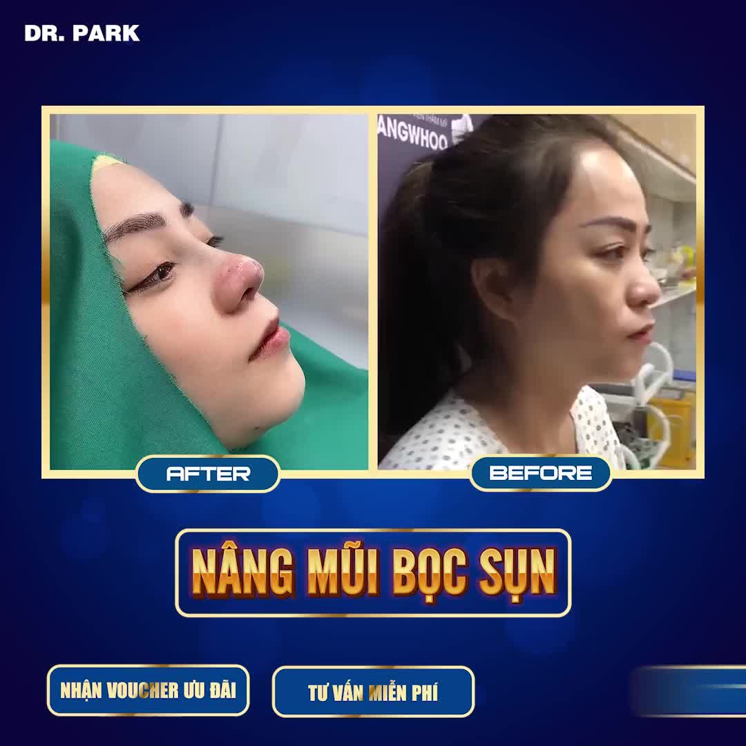 MŨI BỌC SỤN TAI LÀ GÌ DÁNG MŨI NÀO THÌ PHÙ HỢP
