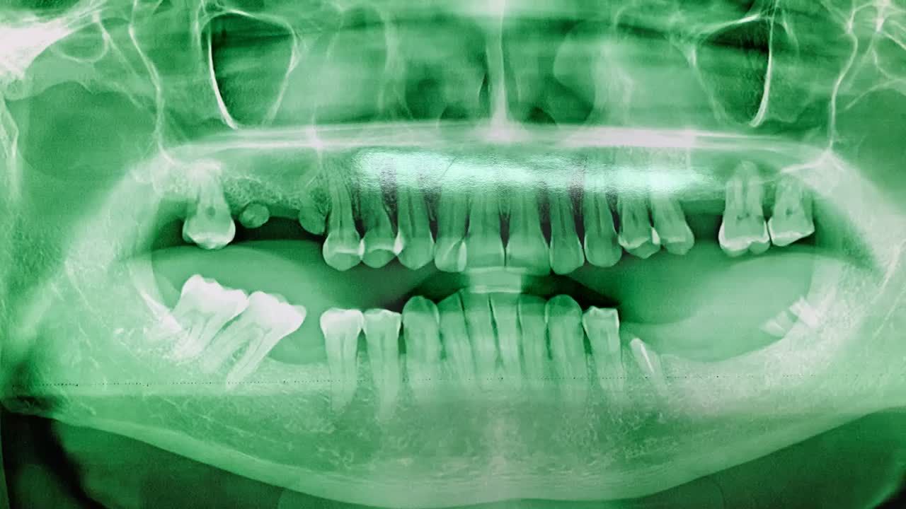 lắp cầu răng implant khôi phục lại 3 răng hàm bị mất.