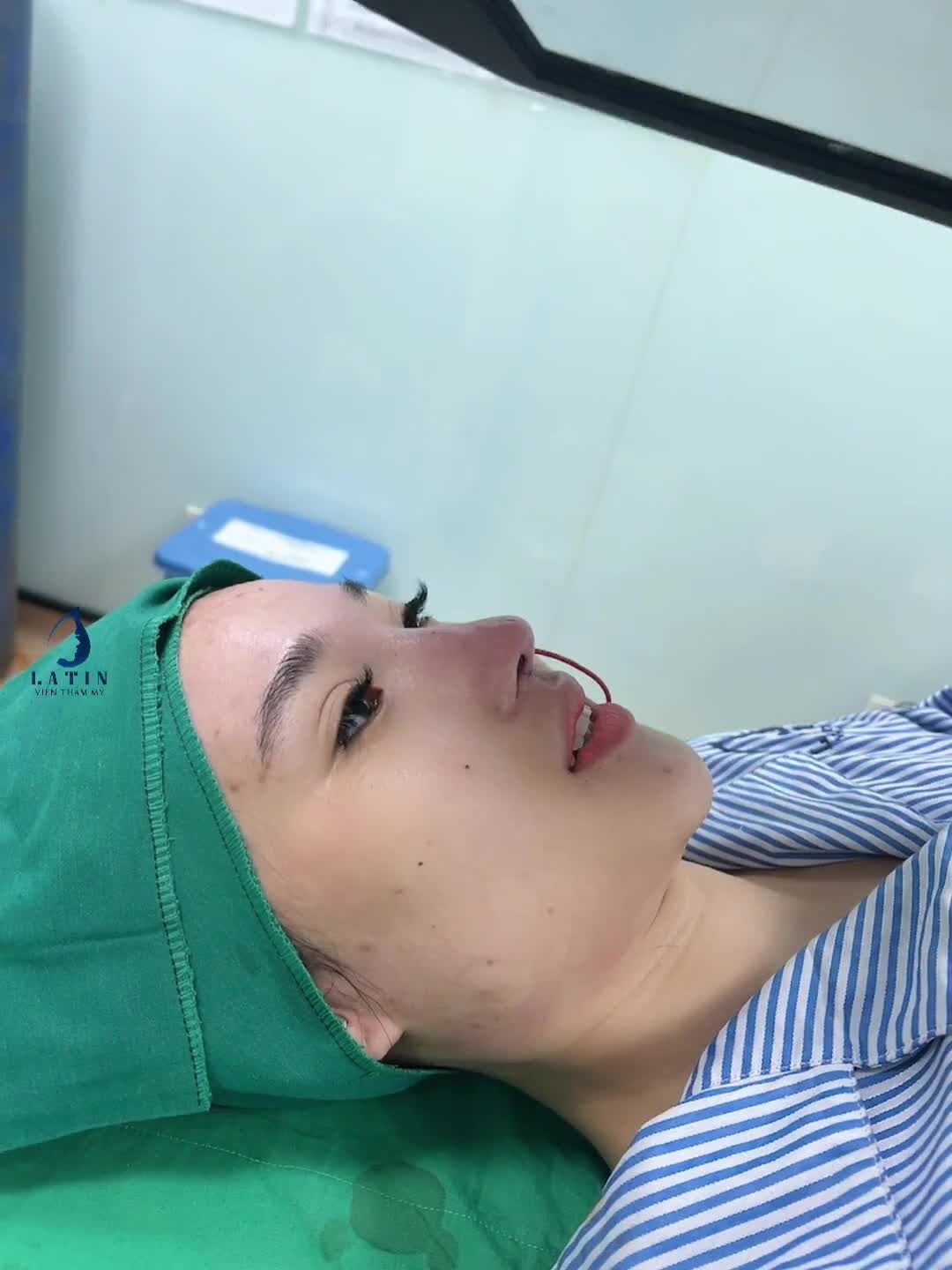 Mũi sửa lại cho em gái bị bao xơ