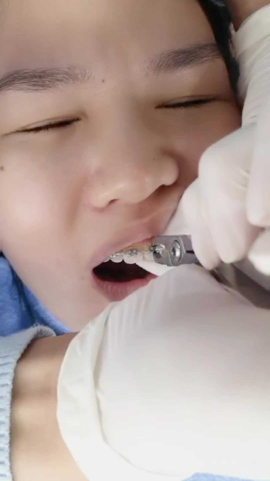 Cận cảnh bước tháo mắc cài niềng răng cho bạn nữ tại Ngân Phượng